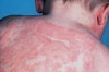 How to Treat Skin Asthma Thumbnail of How to Treat Skin Asthma
