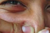 How to Remove Whiteheads from Nose Thumbnail of How to Remove Whiteheads from Nose