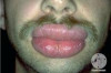 How to Treat a Swollen Lip Thumbnail of How to Treat a Swollen Lip