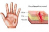 How to Treat Cuts and Scrapes Thumbnail of How to Treat Cuts and Scrapes