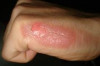 How to Treat a Mild Burn Thumbnail of How to Treat a Mild Burn