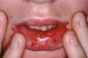 How to Treat Mouth Ulcers Naturally Thumbnail of How to Treat Mouth Ulcers Naturally