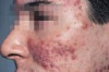 How to Treat Nodular Acne at Home Thumbnail of How to Treat Nodular Acne at Home