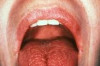 How to Treat Xerostomia Thumbnail of How to Treat Xerostomia