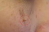 How to Remove Skin Tags with Dental Floss Thumbnail of How to Remove Skin Tags with Dental Floss
