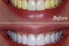 Best Over the Counter Whitening Toothpaste Thumbnail of Best Over the Counter Whitening Toothpaste