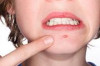 How to Treat Zits under the Skin Thumbnail of How to Treat Zits under the Skin
