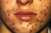 How to Cure Hormonal Acne Naturally Thumbnail of How to Cure Hormonal Acne Naturally