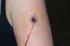 First Aid for Bullet Wounds Thumbnail of First Aid for Bullet Wounds