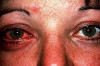 How to Cure Viral Pink Eye Thumbnail of How to Cure Viral Pink Eye