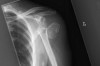 How to Treat Avulsion Fracture Thumbnail of How to Treat Avulsion Fracture