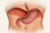 How to Treat Gastroparesis Thumbnail of How to Treat Gastroparesis