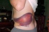 How to Treat Hematoma Thumbnail of How to Treat Hematoma