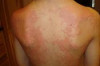 How to Treat Hives Breakout Thumbnail of How to Treat Hives Breakout