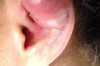 How to Treat Infected Ear Piercing Thumbnail of How to Treat Infected Ear Piercing