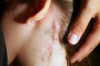 How to Treat Lymph Nodes Thumbnail of How to Treat Lymph Nodes