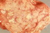 How to Treat Pancreatitis Thumbnail of How to Treat Pancreatitis