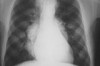 How to Treat Respiratory Infection Thumbnail of How to Treat Respiratory Infection
