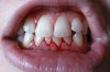 Natural Remedies for Gingivitis Thumbnail of Natural Remedies for Gingivitis