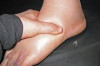 How to Cure Edema Naturally Thumbnail of How to Cure Edema Naturally