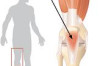 How to Treat Jumpers Knee Thumbnail of How to Treat Jumpers Knee