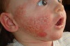 Baby Rashes on Face Thumbnail of Baby Rashes on Face