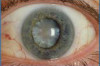 Cataracts Symptoms and Treatment Thumbnail of Cataracts Symptoms and Treatment