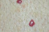 Cherry Angiomas Home Remedies Thumbnail of Cherry Angiomas Home Remedies