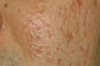 How to Get Rid of Scars from Spots Thumbnail of How to Get Rid of Scars from Spots