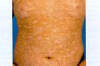 Home Remedies for Hypopigmentation Thumbnail of Home Remedies for Hypopigmentation