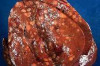 How to Cure Liver Cancer Naturally Thumbnail of How to Cure Liver Cancer Naturally