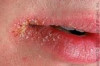 How to Get Rid of Chapped Lips Fast Thumbnail of How to Get Rid of Chapped Lips Fast