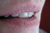 How to Get Rid of Mouth Wrinkles Thumbnail of How to Get Rid of Mouth Wrinkles