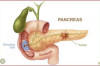 How to Prevent Pancreatic Cancer Thumbnail of How to Prevent Pancreatic Cancer