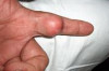 How to Relieve Cyst Pain Thumbnail of How to Relieve Cyst Pain