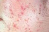 How to Treat Acne Internally Thumbnail of How to Treat Acne Internally