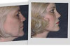 Neck Lift Surgery Cost Thumbnail of Neck Lift Surgery Cost