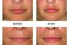 Permanent Lip Augmentation – Before and After Photos & Cost Thumbnail of Permanent Lip Augmentation – Before and After Photos & Cost