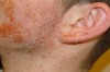 How to Treat Pityriasis Rosea Thumbnail of How to Treat Pityriasis Rosea