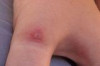 Spider Bite Home Remedies Thumbnail of Spider Bite Home Remedies