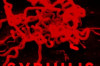 How to Treat Syphilis Thumbnail of How to Treat Syphilis