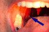How to Cure Tonsil Stones Naturally Thumbnail of How to Cure Tonsil Stones Naturally