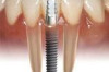 Dental Implants Cost – Manila Philippines Thumbnail of Dental Implants Cost – Manila Philippines