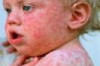 German Measles Symptoms and Treatment Thumbnail of German Measles Symptoms and Treatment