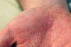 What Does the HIV Rash Look Like? Thumbnail of What Does the HIV Rash Look Like?