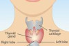 How to Treat Hypothyroidism Naturally Thumbnail of How to Treat Hypothyroidism Naturally