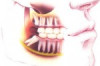 Impacted Wisdom Teeth Removal Cost Thumbnail of Impacted Wisdom Teeth Removal Cost