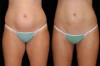 Laser Liposuction Side Effects Thumbnail of Laser Liposuction Side Effects