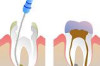 Root Canal Cost in Philippines Thumbnail of Root Canal Cost in Philippines