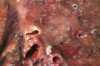 How to Treat Bronchopneumonia Thumbnail of How to Treat Bronchopneumonia